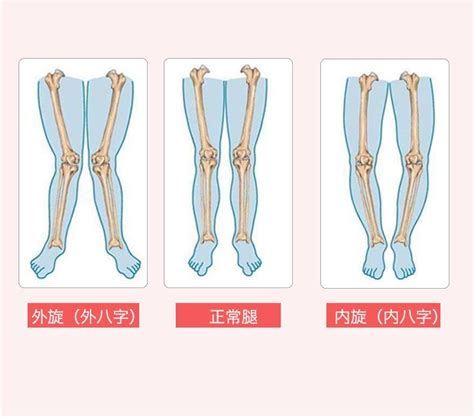 外八字腳